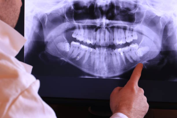 Best Emergency Root Canal Treatment in Hughson, CA